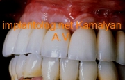 Имплантация зубов и фиксация с помощью усиленной  армированной конструкции